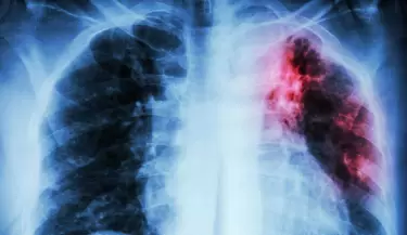 Tuberculosis(1)