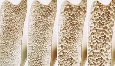 osteoporosis