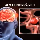Cómo es el ACV hemorrágico, el mazazo inesperado que acabó con la vida de Alejandro Bermejo