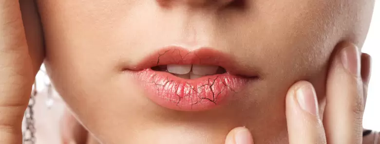 labios-resecos belleza