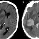 Qu� es el linfoma cerebral, el tipo de c�ncer que enfrenta Raphael