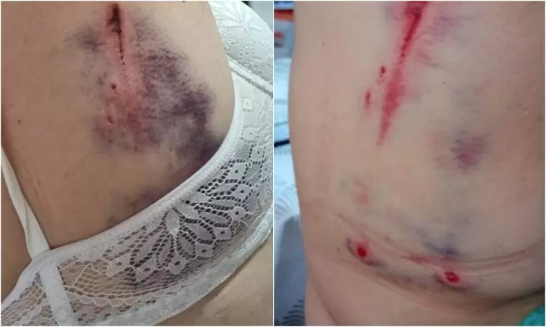 Ataque a una anciana por un dogo argentino
