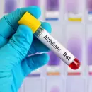 Un an�lisis de sangre detecta el Alzheimer con m�s del 94% de precisi�n