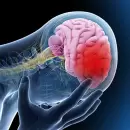 Aumento preocupante de accidentes cerebrovasculares en adultos j�venes y mujeres: posibles causas
