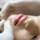 Cada vez más mujeres menores de 40 se hacen cirugías de rejuvenecimiento facial
