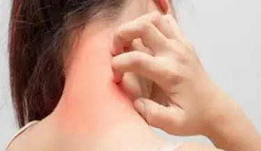 alergia