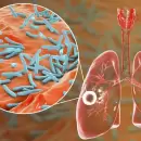 Tuberculosis en baja: Mendoza alcanza una incidencia hist�rica, mientras aumentan los casos en el pa�s