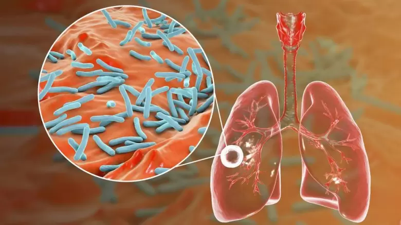 tuberculosis