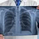D�a Mundial del C�ncer de Pulm�n: alertan sobre el aumento de casos