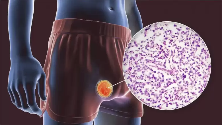 Cancer testicular